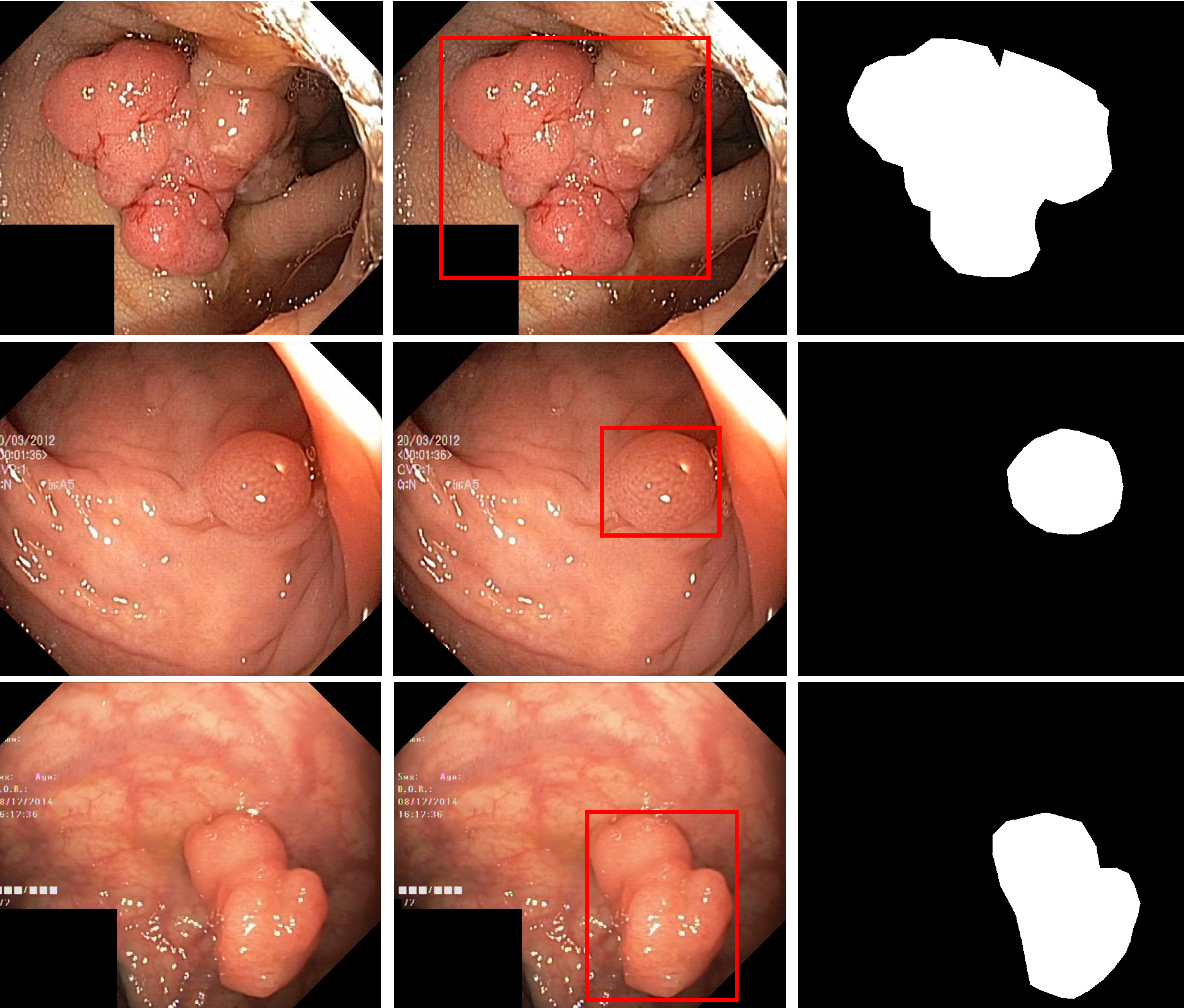 Polyp